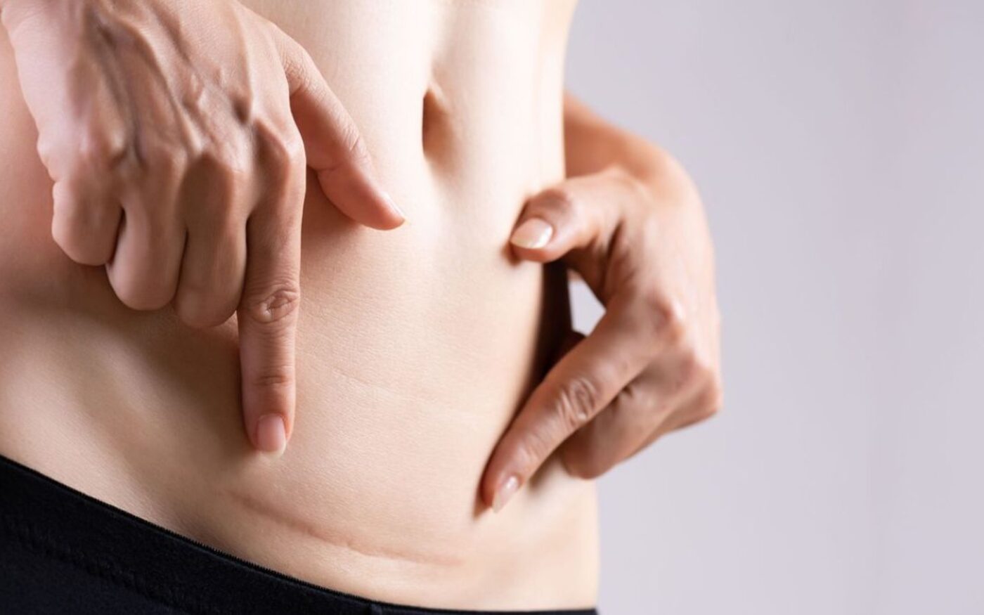 Vrouw wijst het litteken van een keizersnede aan op haar onderbuik